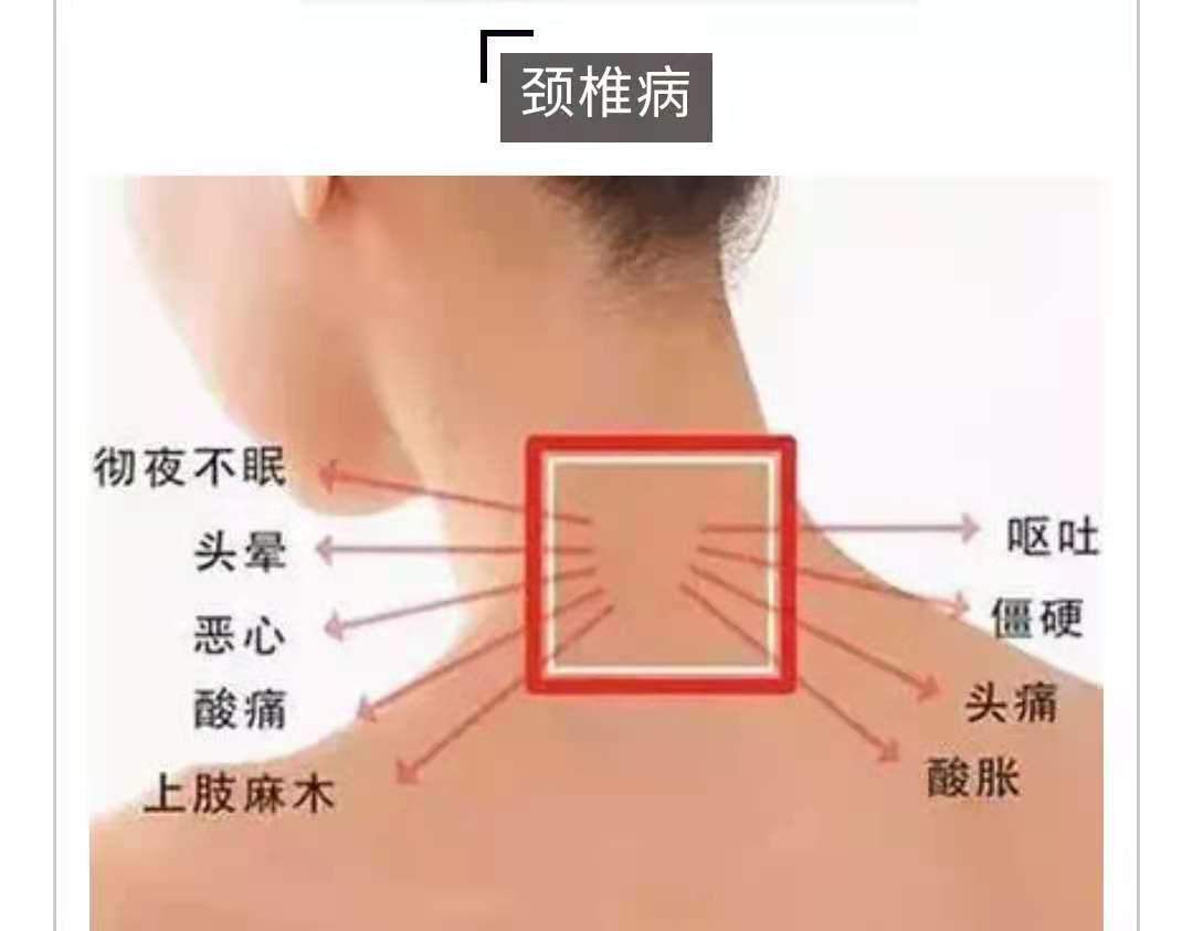 峰哥说表|自用颈椎病药贴,千万不要乱用