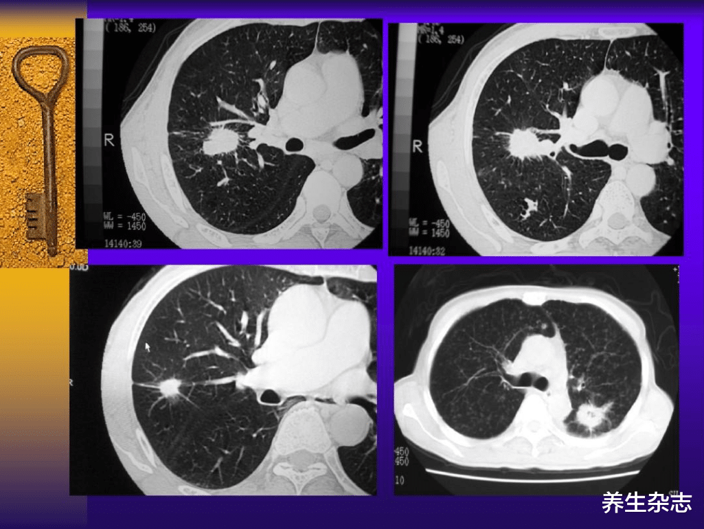|呼吸科主任:开水中扔一把,没事天天坚持喝,冲走结节,肺感激你