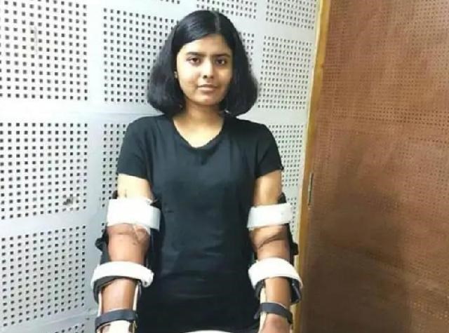 印度女孩因車禍失去雙臂，移植黑人手臂，2年後全身皮膚開始變黑-圖4