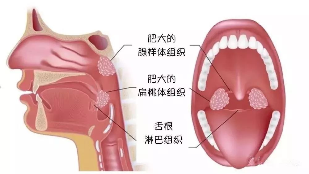 耳鼻喉申医生 当心！别让腺样体肥大成为孩子的“颜值杀手”
