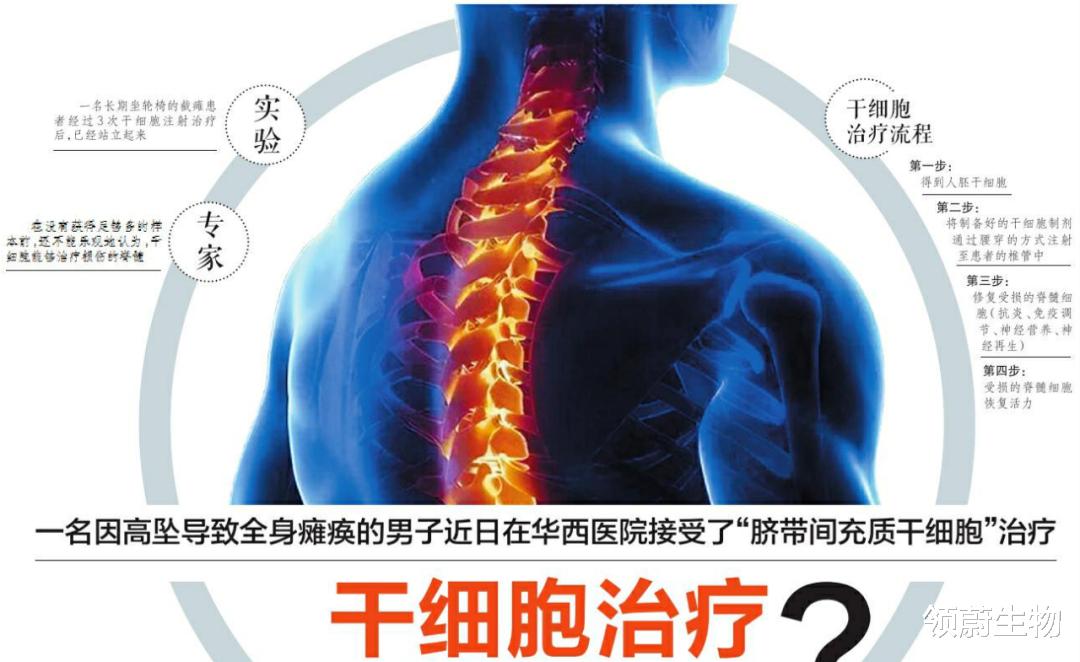 四川大学华西医院 国内干细胞新进展：全身瘫痪患者在华西医院接受脐带间充质干细胞