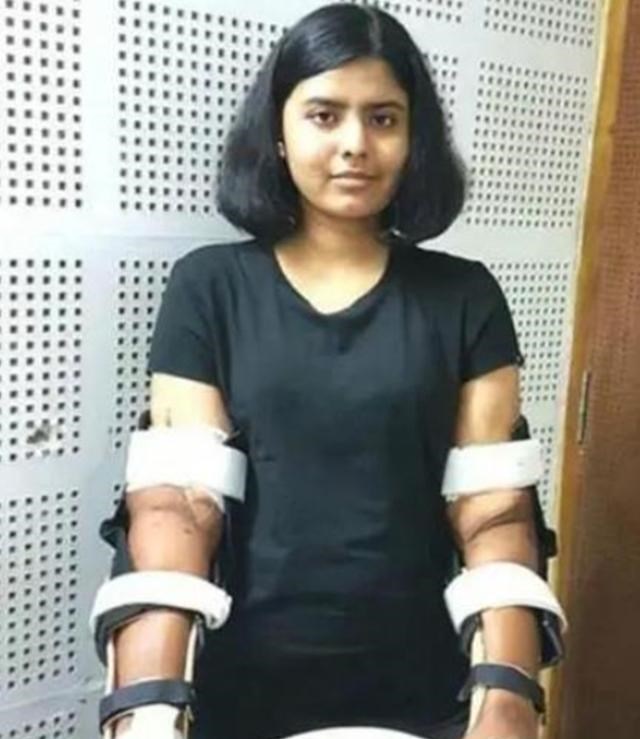 印度女孩因車禍失去雙臂，手術移植黑人手臂後，全身皮膚開始變黑-圖4