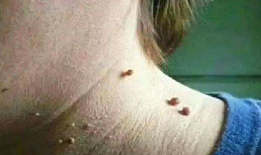 恋恋健身|脖子和腋下的“小肉粒”是什么？小肉粒可以用手拉吗？