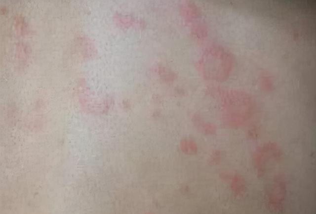 荨麻疹|夏天是荨麻疹高峰期