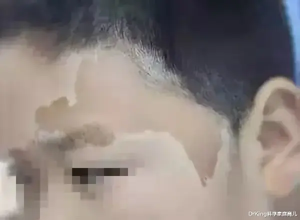 DrKing科学家庭育儿|听过100种胎记的传说,有人告诉你这几种胎记可致命吗?