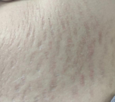 fashion美尚|那些号称可以“预防妊娠纹”的方法和乳油膏霜，原来都是智商税