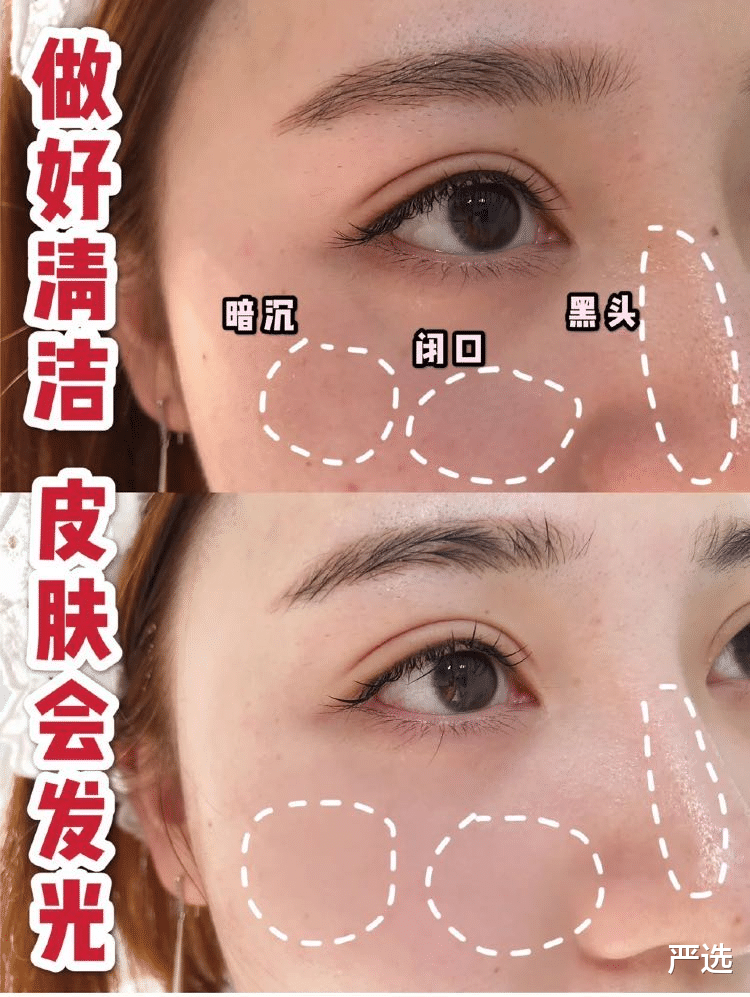 严选|为抗老注射“玻尿酸”变面瘫的女人,现在啥样?过来人:追悔莫及