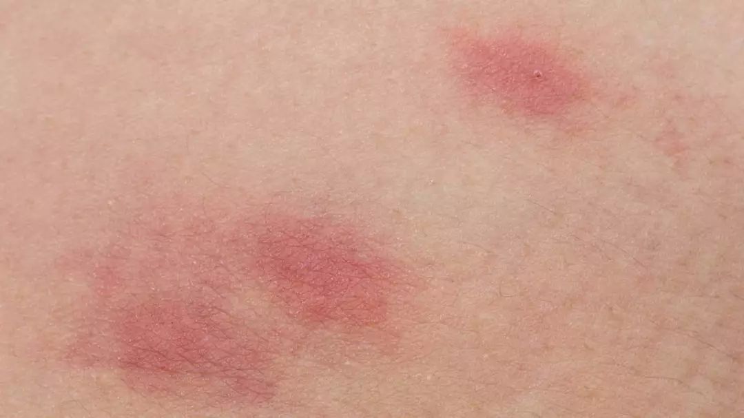 朱医生讲健康 不要错把艾滋病当皮肤病，皮肤出现3种情况，可能是艾滋发信号