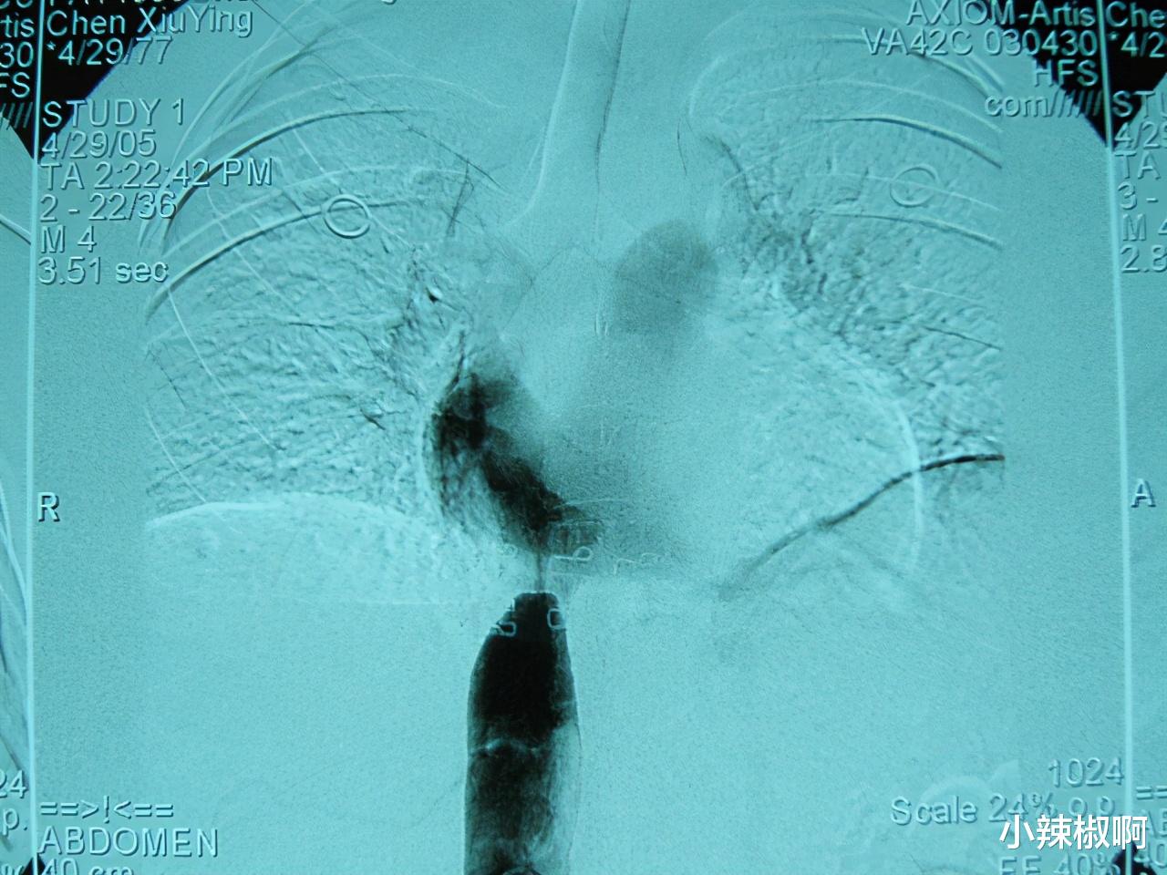 小辣椒啊 非常病例——疑难病年轻女患者崇尚科学，得到迅速治疗和长期效果