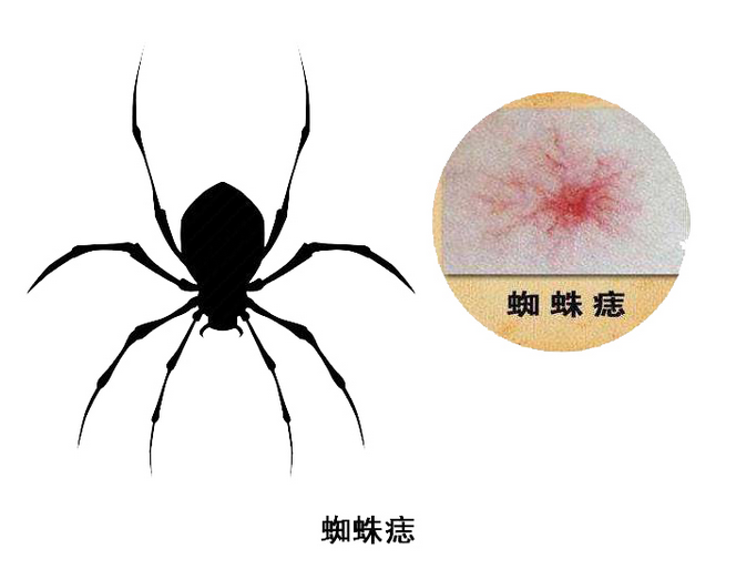 六味地黄丸|肝硬化的人，脸上会有3种异常，占一个，也要重视起来