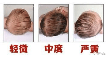 小特麻麻|头型影响颜值？如何帮助宝宝睡出完美头型？
