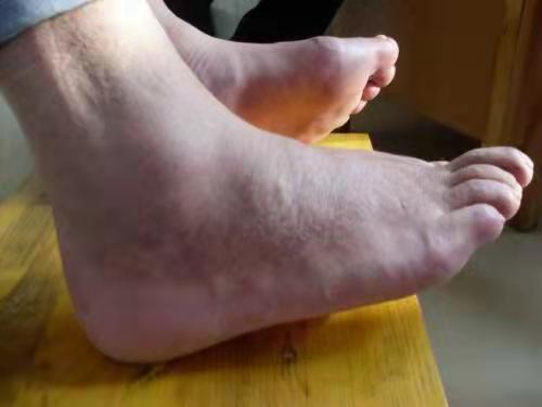 痛风|提醒大家：若关节处有3种异常信号，警惕被痛风找上门，及时调理