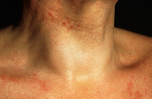 甲状腺结节|甲状腺的“知音”已找到,并非无花果,甲乳科主任:你若爱吃,结节无处藏身