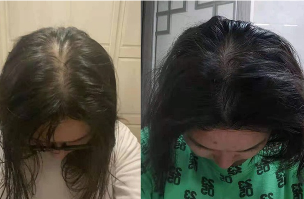 张医生科普|为什么越来越多的年轻人开始脱发、秃头？医生：有可能患上这3种疾病