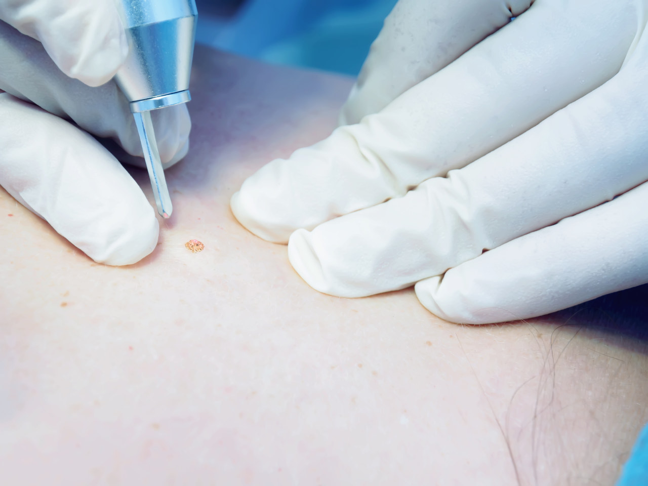 白萝卜|皮肤上的小肉球、小肉疙瘩是什么？不出意外，这4种可能性较大