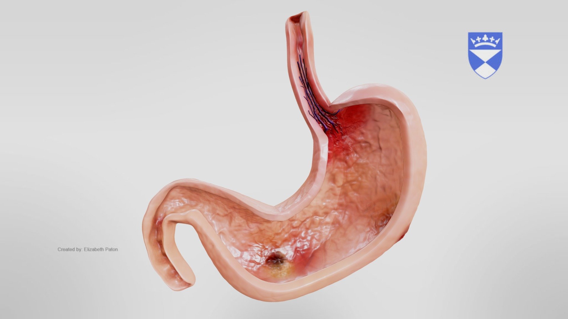 胃癌|国外胃癌越来越少,我国却逐渐增多?是食物不行,还是习惯问题?