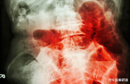 便秘|鸡蛋是便秘的“发物”?医生提醒:想肠道畅通,3种“素食”可多吃