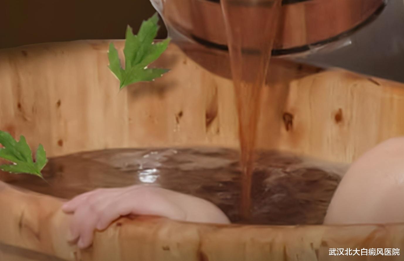 武汉北大白癜风医院|中医药浴，白癜风患者泡一泡的祛白疗法