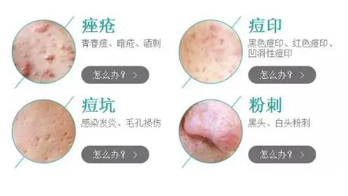 膳食一度|“青春痘”为何难以消除？国内外痤疮的治疗标准在这里！