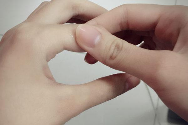 血糖|判断自己的血糖高不高，不妨看下手上有无这5个表现，早做了解