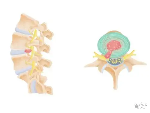 腰椎间盘突出|腰椎间盘突出保守治疗，结局是什么？