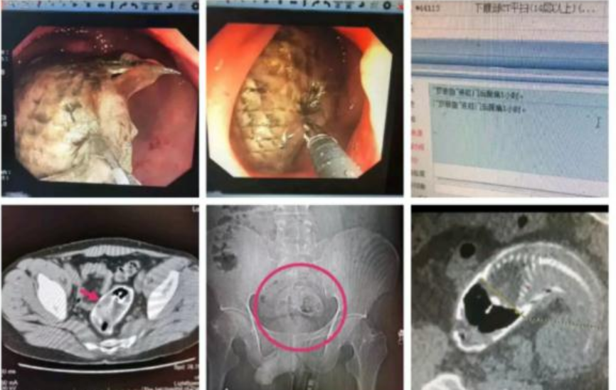 兜妈爱叨叨 14岁男孩效仿“荒野求生”，把活龙虾塞进肛门，自称会变成龙虾干