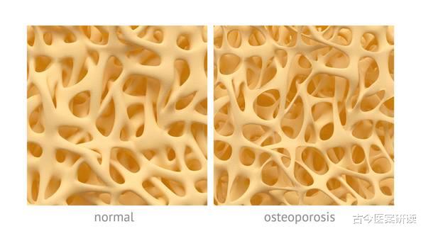 骨密度|吃一口相当于6袋盐，医生：若你经常吃，骨密度流失如“沙漏”