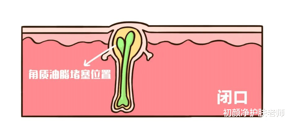 黄芪 建议有“闭口”的女生，坚持做好这几件事，高效解决不反复！