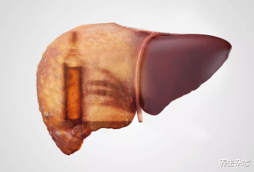 肝脏|42岁大哥喝酒20年，肝脏依然健康柔软，医生：酒后3习惯值得学习