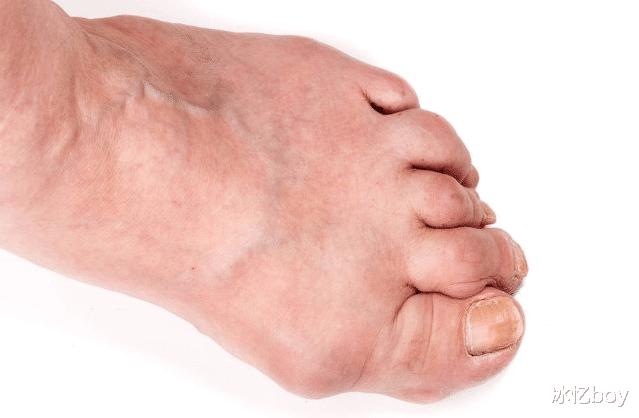 尿酸|47岁男子滴酒不沾,痛风反复,提醒:常喝2种水,或会使尿酸快速升高