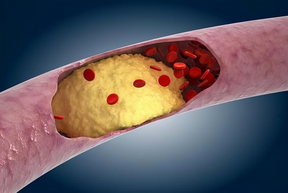 高血脂|“刮油机”登场，血液黏稠如粥又如何，照样将血液稀释干净