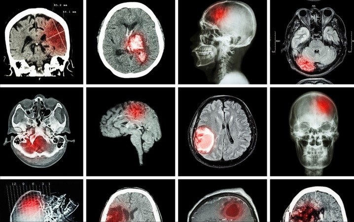 脑梗|一人脑梗，全家遭殃，做好这3事，血管洁净通畅，比吃8斤木耳还管用