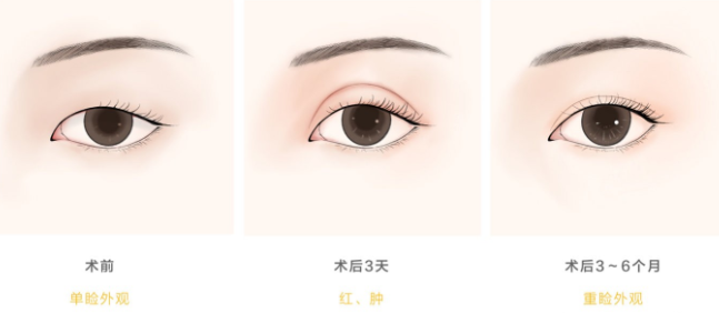 史迎军眼整形|史迎军眼整形 | 双眼皮术后5问，想做双眼皮还不快来了解一下