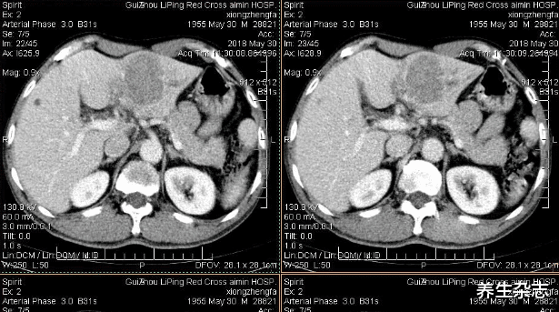 肝脏|花季少女一月20次“857”，3个月后离世，医生：肝脏早已“烂如渔网”