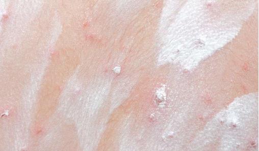 图图爸爸|夏天孩子容易出痱子，怎么办？了解原因，针对情况护理是关键