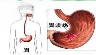 消化内科石医生 消食片会引起胃溃疡和发育不良，尤其是学龄期孩子！是真的吗？