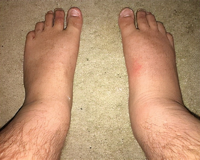 咳嗽|55岁突然发胖，医生却说是水肿？4种常见原因，表现各不相同