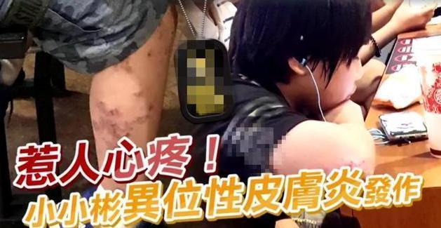 小小彬|2岁出道3岁被亲妈抛弃，拼命赚钱却被继母挥霍一空，17岁手脚溃烂