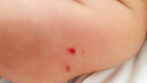 体检|医生眼里的6种“善良瘤”，确诊后先别慌，恶化概率很低