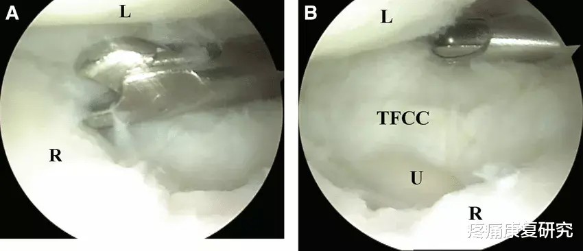 便秘|三角纤维软骨损伤与康复治疗