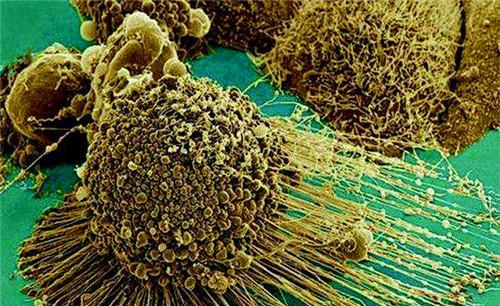 癌细胞 她是拥有不死细胞的人，让许多癌症患者因此得救，至今仍在造福人类