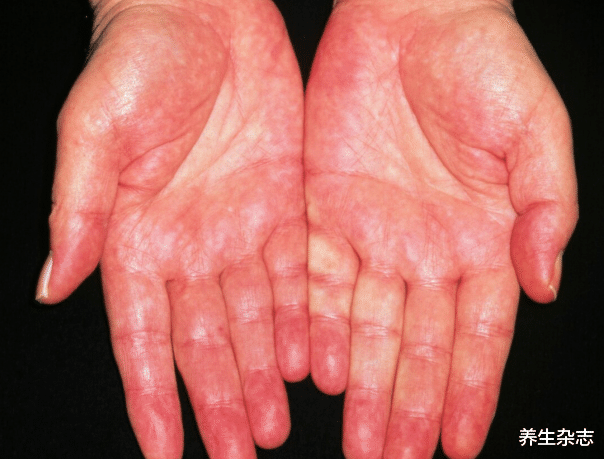 养生杂志|夫妻双双确诊肝癌,医生提醒:厨房这“1物”可能致癌,要及时清洗