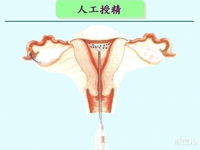 添宝儿|人工授精和试管婴儿如何选择