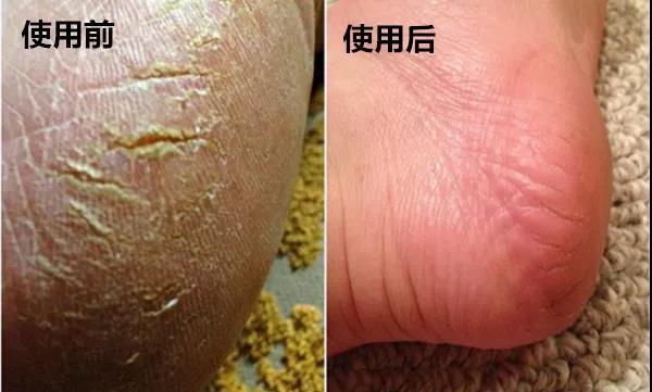 美容养颜 秋冬季，涂身体乳和不涂的差别竟然这么大！
