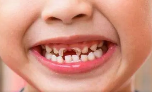 林文武|保护孩子牙齿，从正确咀嚼方式做起