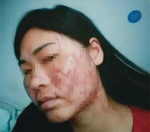 脸被小三划百刀毁容,妻子愤而状告丈夫重婚,一双儿女却支持爸爸
