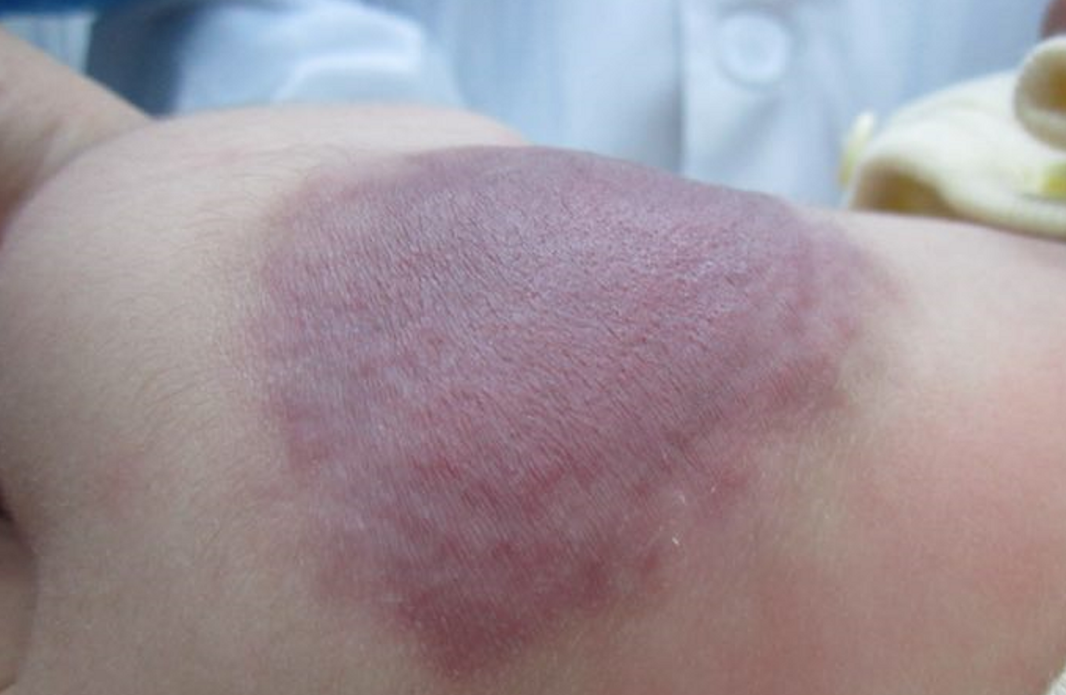 父母育儿观|40%宝宝胎记不是来自遗传，更多是因为孕妈，孕期太放纵四个行为