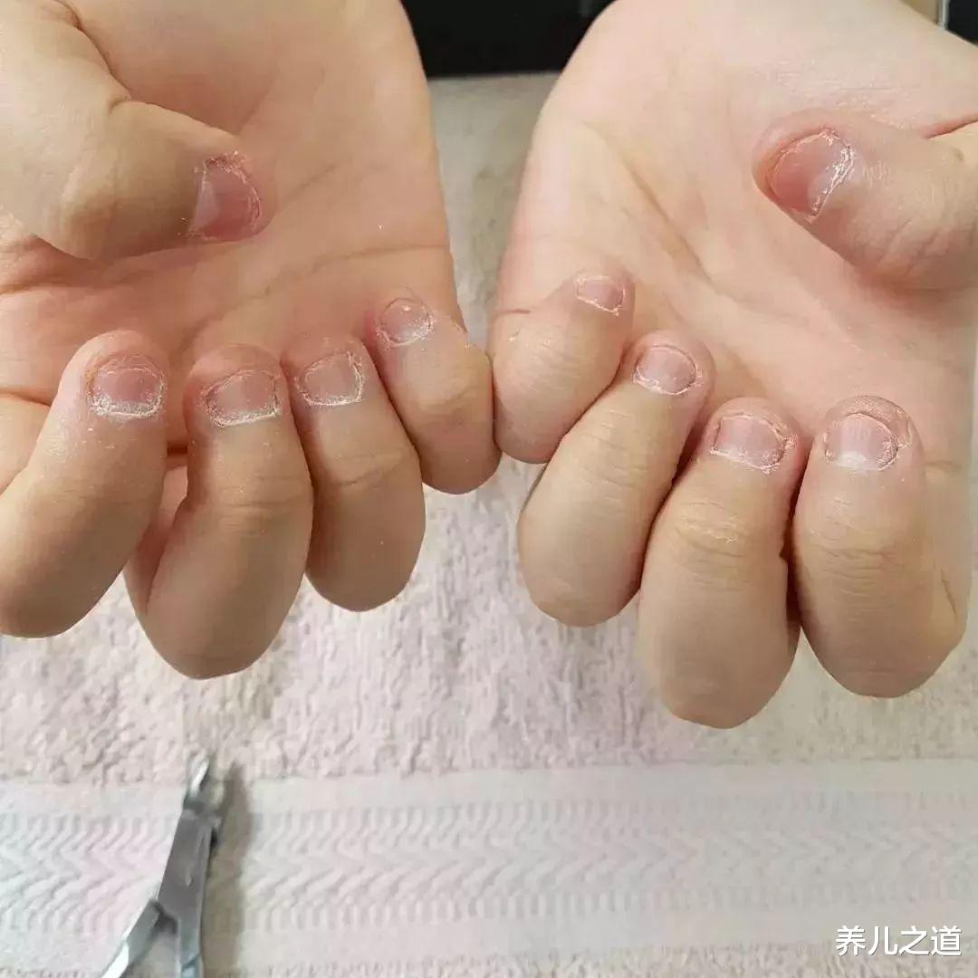 养儿之道|总是把指甲咬到秃的孩子,长大会面临三种困境,现在纠正还不晚