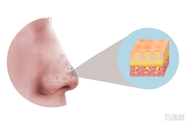 螨虫|冬天人体容易被螨虫“袭击”，教你几招，有效除螨