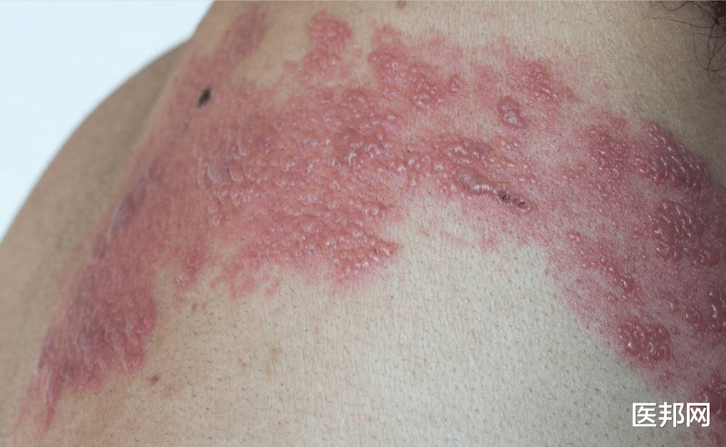 疾病|除了心肌梗死，这些疾病也可以引起胸痛，教大家鉴别